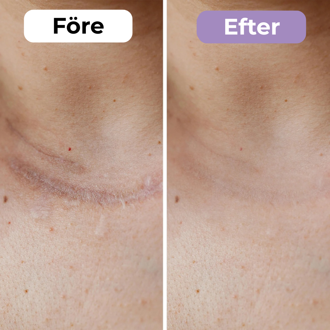 SilkoLapp™ - Proteção suave para uma pele mais suave