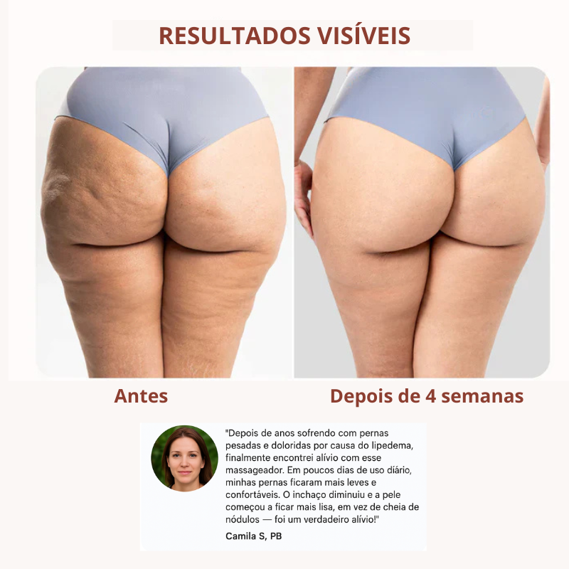 Drena Roller – Massajador Linfático para Lipedema e Celulite