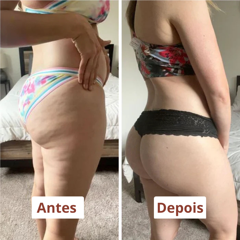 Drena Roller – Massajador Linfático para Lipedema e Celulite