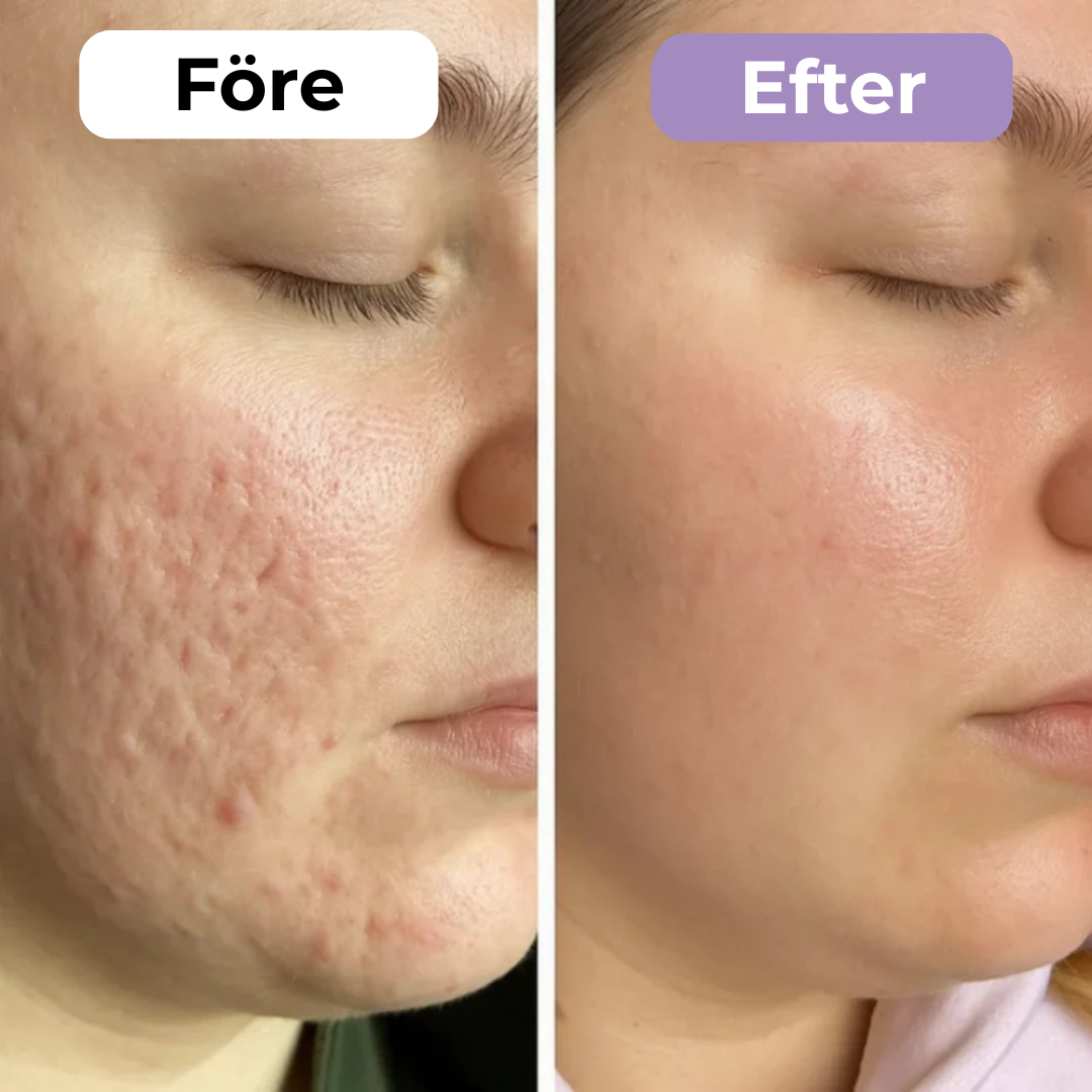 SilkoLapp™ - Proteção suave para uma pele mais suave