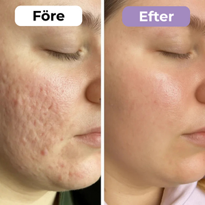 SilkoLapp™ - Proteção suave para uma pele mais suave