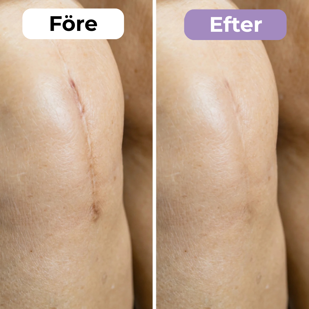 SilkoLapp™ - Proteção suave para uma pele mais suave