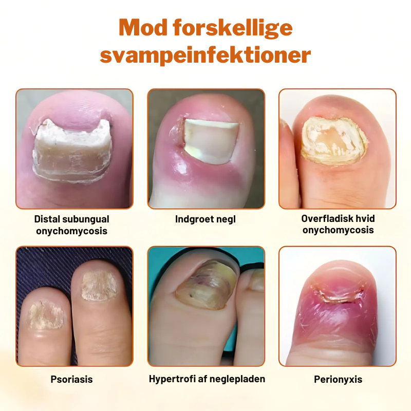 FungiStop – Spray de Cuidado de Unhas Antifúngico Avançado